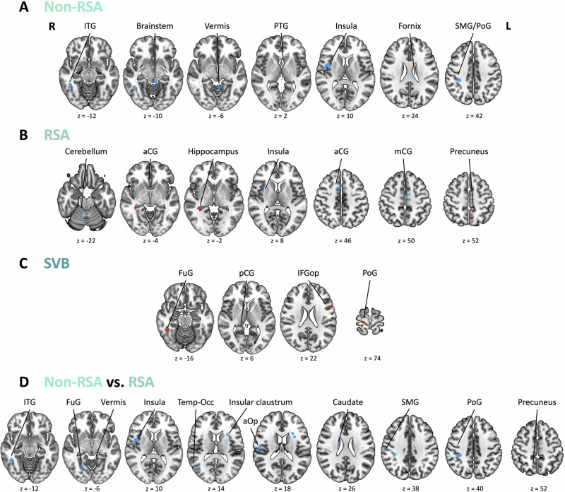 Fig. 2. Brain regions showing significant HRV-related BOLD response differences between patients with MDD and HC.Axial slices are displayed for each contrast: A non-RSA regressor; B RSA regressor; C SVB regressor; and D non-RSA vs RSA contrast. Red indicates MDD > HC; blue indicates MDD < HC (ITG inferior temporal gyrus, PTG paraterminal …